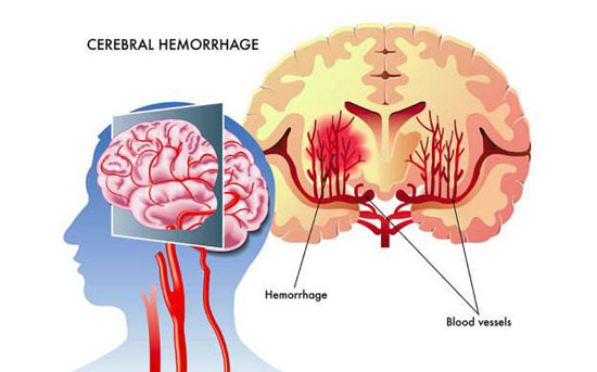 脑出血处理不及时或导致认知功能障碍