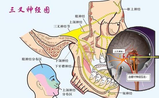 三叉神经痛明确诊断去除病因微血管减压术后不会再复发