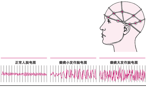 癫痫脑电图类型1.jpg