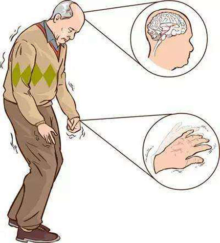 帕金森病患者1.jpg
