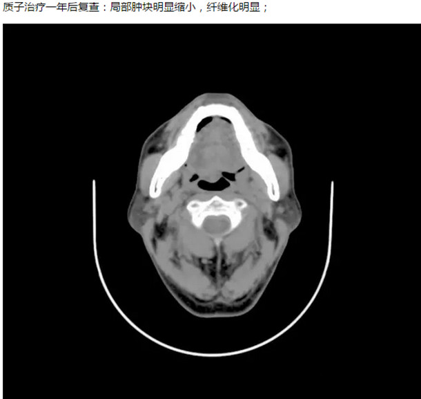 舌根癌质子治疗存活八年