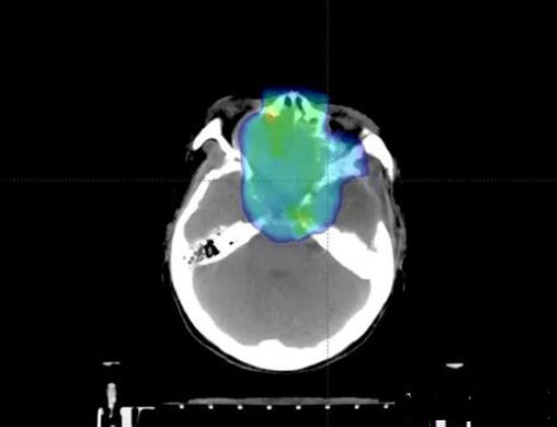 无法手术巨大脑膜瘤4.png