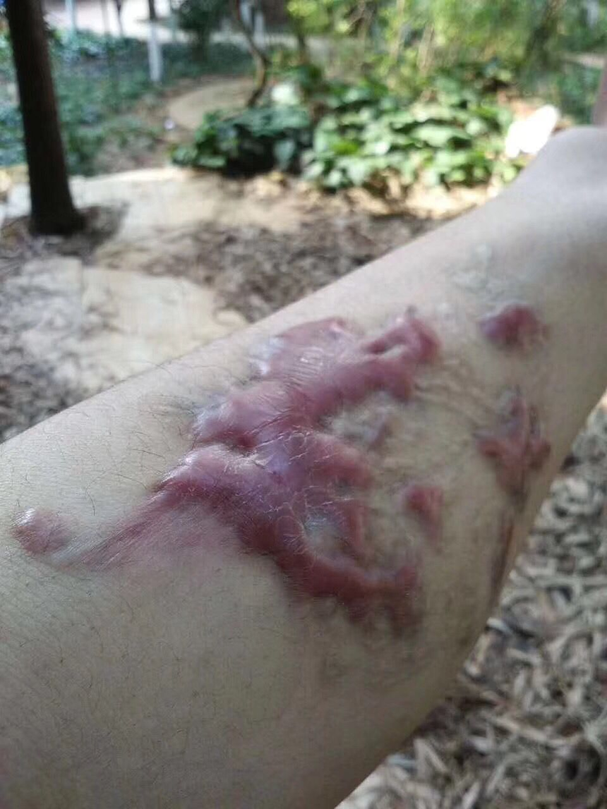手臂疤痕疙瘩修复