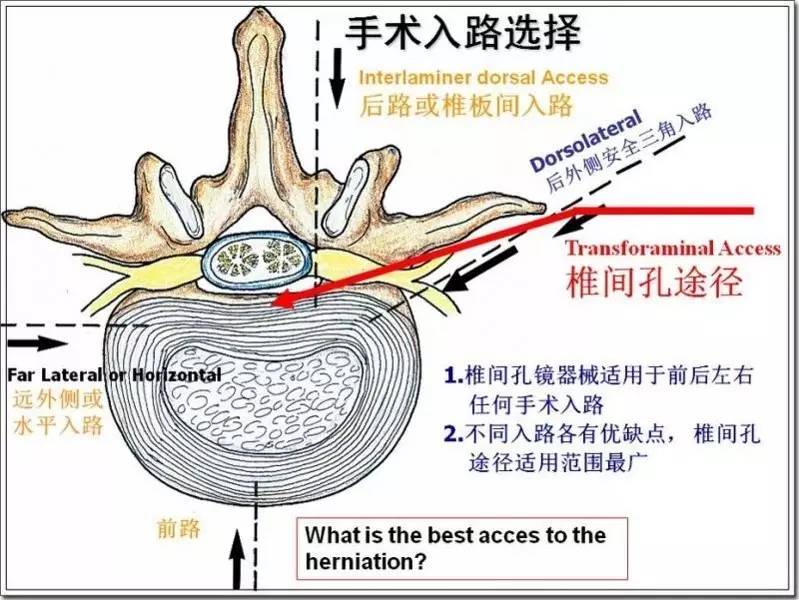 骨科脊柱可视微创椎间孔镜手术系统