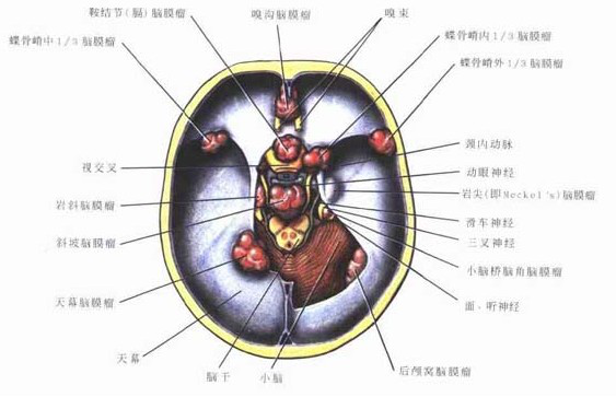 脑膜瘤示意图图片