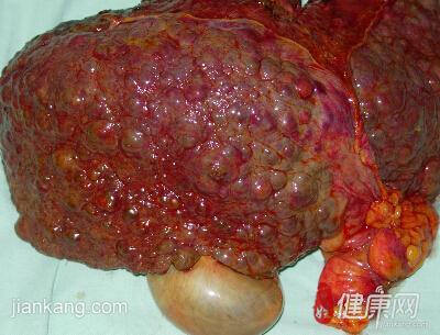 肝血管畸形图片