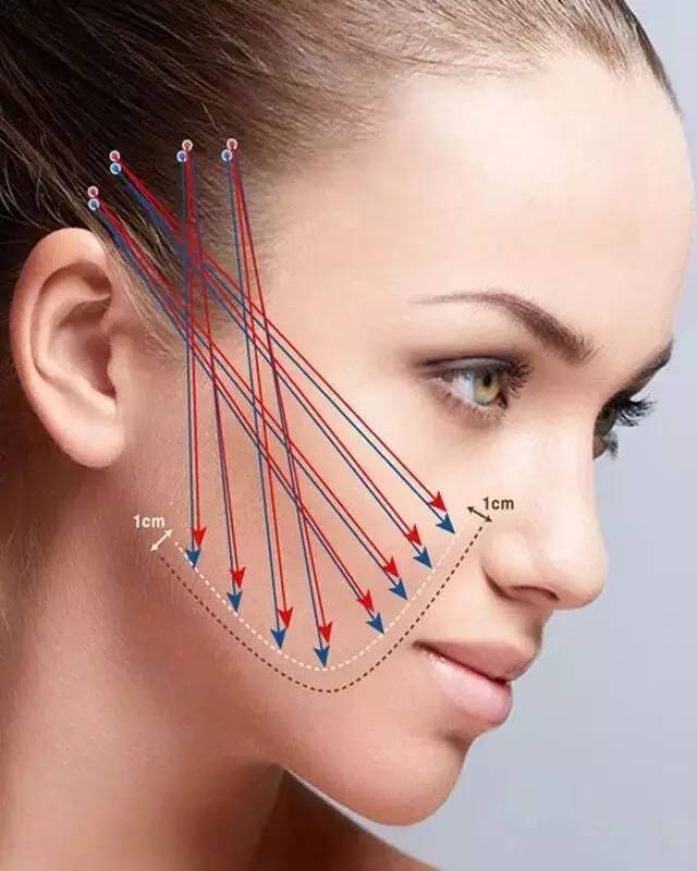 美容项目  脸型轮廓 面部提升 多维魔力提拉——女人颜值的生命线